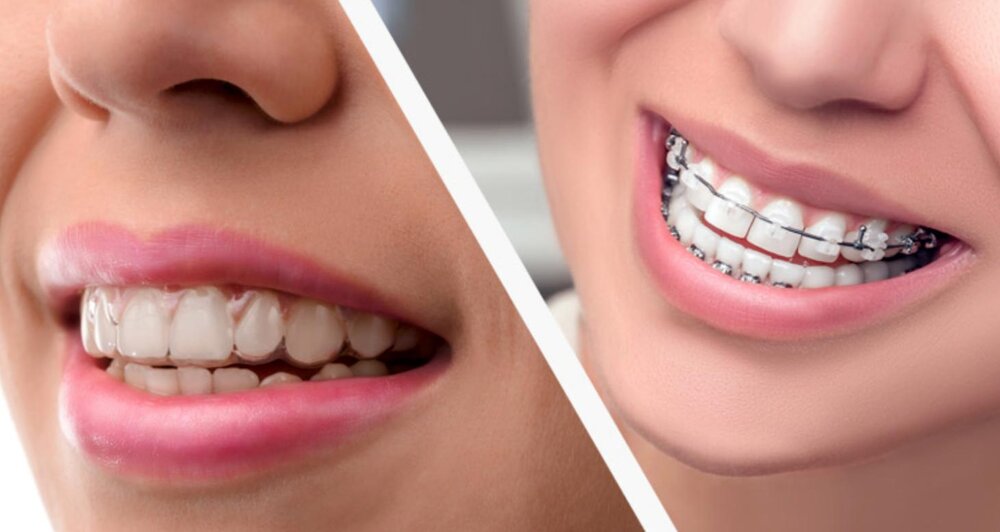 braces-vs-invisalign