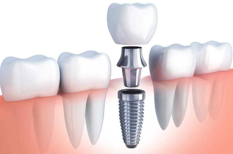 dental-arts-of-atlantis-dental-implants