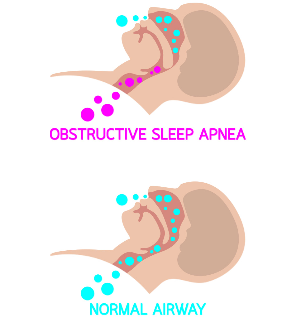 Sleep Apnea Diagram – Dental Arts of Atlantis